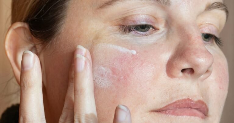 Femme appliquant une crème apaisante sur peau avec rougeurs et rosacée