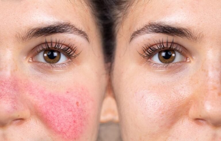 Avant après traitement rougeurs visage rosacée peau sensible